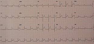 Myocarditis is classified as a rare disease but is estimated to affect thousands of adults and 3.1 million cases of myocarditis were diagnosed in 2017 (statistics posted in lancet, november 2018). Myocarditis Wikipedia