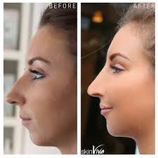 Your wide nose is now contoured and will look thinner and more attractive. How Dermal Fillers Can Make Your Nose Look Smaller Skinviva