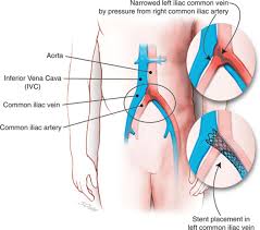 Inferior Vena Cava Filters May Thurner Syndrome And Vein Stents Circulation
