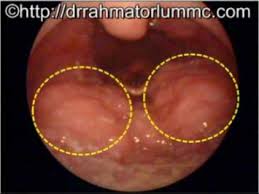 Pain that occurs when swallowing Lingual Tonsillitis Youtube