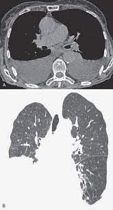 Often, pleural effusions are found incidentally on chest radiographs requested for another acute it requires a suitably trained and competent user to be safe and effective. Pleural Effusion Radiology Key