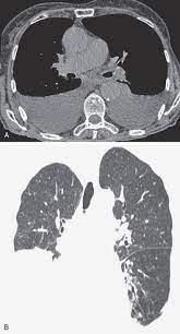 Send aspirated fluid for cytology. Pleural Effusion Radiology Key