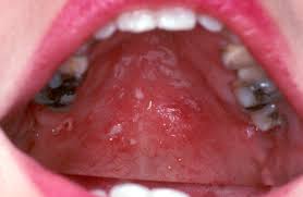 Image result for Mouth ulcers symptoms roof of the mouth
