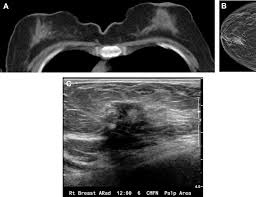 Image result for Incidental Imaging Finding