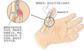 因此當你有以下症狀時，就有可能是患上網球手： 前臂筋腱感到疼痛、 手肘屈曲時覺得痛、 扭毛巾或拿東西時感到疼痛、 手臂感到酸軟無力。 如果你有懷疑以上的症狀，就表示你有可能患上網球手! æ‰³æœºæŒ‡ å¦ˆå¦ˆæ‰‹ ç½'çƒè‚˜ å®ƒä»¬éƒ½å«è…±éž˜ç‚Ž æ²»ç–—çœ‹è¿™é‡Œ è…±éž˜ç‚Ž è…±éž˜ç‚Ž