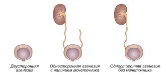 Maybe you would like to learn more about one of these? Chto Takoe Aplaziya Ageneziya Pochki