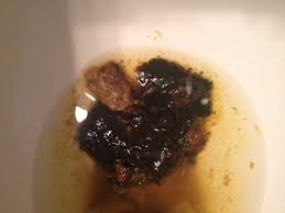 Image result for dark black stool human poop