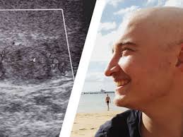 When a testicular tumor metastasizes, it does so in a relatively predictable pattern. Testicular Cancer Taking Care Of Myself Klinik Kompass