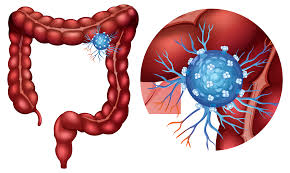 Image result for Constipation in Cancer