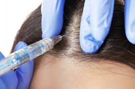 Alopecia Areata Treatment | APAX Medical & Aesthetics Clinic