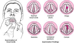The most significant chemical cause of cancer is tobacco; Overview Of Laryngeal Disorders Ear Nose And Throat Disorders Msd Manual Professional Edition