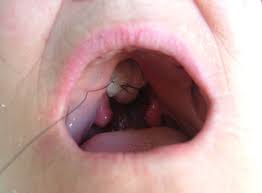 Maybe you would like to learn more about one of these? Intraoral View Of The Tampon Inserted Into Maxillary Defect Download Scientific Diagram