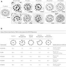 Scp 3199 двуногие без перьев. Rsph3 Mutations Cause Primary Ciliary Dyskinesia With Central Complex Defects And A Near Absence Of Radial Spokes Abstract Europe Pmc