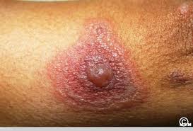 Image result for Erythema Multiforme Major