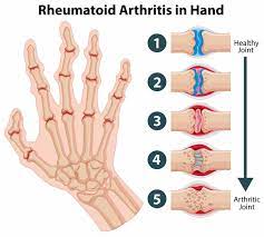 What is a rheumatoid arthritis rash? Rheumatoid Arthritis Ra Anova Irm Germany
