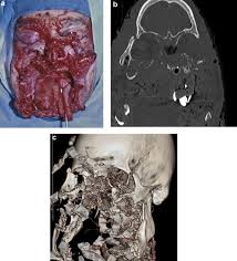 The forensic necropsy is described, including gunshot wound. Gun Orientation In Self Inflicted Craniomaxillofacial Gunshot Wounds Risk Factors Associated With Fatality Pocket Dentistry