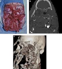 Gunshot wounds are particularly prone to anaerobic infection, especially tetanus and gas gangrene. Gun Orientation In Self Inflicted Craniomaxillofacial Gunshot Wounds Risk Factors Associated With Fatality Pocket Dentistry