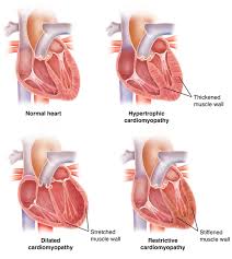 Image result for Restrictive Cardiomyopathy
