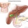 As the cancer grows it can start to cause symptoms. 1
