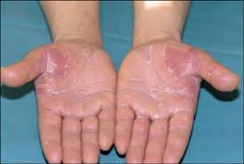 These are the main causes that can lead to the appearance of palmar erythema: Palmar Erythema With Fissuration Palmar Plantar Erythrodysesthesia Download Scientific Diagram