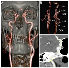 Image result for carotid artery