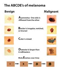 Melanomas are most often caused by overexposure to uv light, either through tanning beds or natural sunlight. Malignant Melanoma Symptoms The Guide Ways