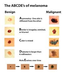 To diagnose subungual melanoma, your healthcare provider will likely perform a biopsy.most often, your provider will numb the affected toe. Enter Melanoma