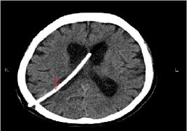 Postoperative Ct Scan Of The Patient Axial View Showing Placement Of Download Scientific Diagram