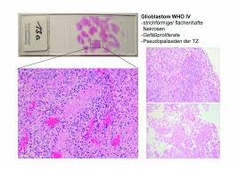 Pns, systema nervosum periphericum englisch: Tumoren Des Zns Pns Und Der Meningen El Iph Organpathologie Atlas