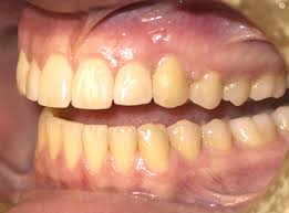 Drink lots of water and swish water around your mouth after you smoke or drink coffee or tea. How To Avoid Being Plagued By Yellow Teeth Westermeier Martin Dental Care