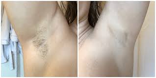 Plus a sneak peek at what just one visit did! Laser Hair Removal St Louis Before After Review Fantabulosity