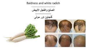 They do work if used correctly. Baldness And White Radish Ø§Ù„ØµÙ„Ø¹ ÙˆØ§Ù„ÙØ¬Ù„ Ø§Ù„Ø£Ø¨ÙŠØ¶ Ganja Pan Youtube