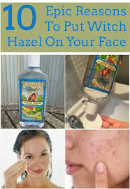 10 Epic Reasons To Put Witch Hazel On Your Face Skin Dry Skin On Face How To Treat Eczema Skin Care Remedies