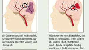 Einfach Absaugen Wissen