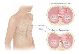 Check spelling or type a new query. Pectus Excavatum Chest Wall Stanford Children S Health