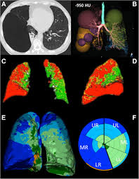 Want to learn more about it? Lung Parenchyma Representations At Ct Scan After Post Processing With Download Scientific Diagram