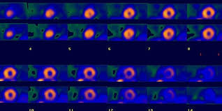 Image result for Nuclear Ventriculogram