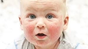 Image result for vyrážka u dětí