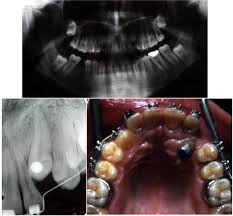 Despite the unconcealed allocation, the outcome duration of canine's eruption is probably in low risk of bias as the protocol of open and closed technique is mentioned clearly, any possible confounders (age, depth of impaction) have similar distribution at baseline among groups and the definition of eruption is objective. Clinical Consideration And Management Of Impacted Maxillary Canine Teeth Intechopen