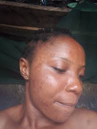 Hi guys what home remedies can I use to remove dark spots and pimples  please help guys my face is a disaster