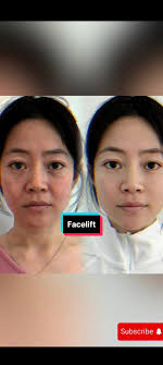 Facelift Transformation: Before and After Results