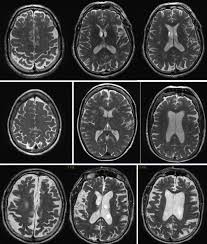 Ct scan (computer tomography) and pet scan (positron emission tomography) are different but the compound was first administered to two normal human volunteers by abass alavi in august 1976 at the advantages of pet vs. Convolution Neural Network Based Alzheimer S Disease Classification Using Hybrid Enhanced Independent Component Analysis Based Segmented Gray Matter Of T2 Weighted Magnetic Resonance Imaging With Clinical Valuation Sciencedirect