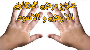 علاج البرص اعراض مرض البرص وطيفية علاجه عبارات