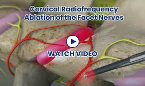 Image result for Radiofrequency Surgery