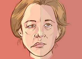 Le traitement d'une hémiplégie repose principalement sur le traitement de la cause dans le but de faire régresser, ou au. Paralysie Faciale Definition Symptomes Traitement Sante Sur Le Net