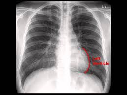 Chest X Ray Cxr Analysis In A Nutshell X Ray Radiology Lunges