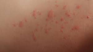 What S That Rash With Pictures Queensland Health