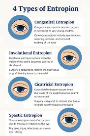 Image result for Entropion