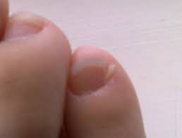Dry skin between the toes is usually caused by a fungal infection known as athlete's foot. My Split Little Toenails Or Accessory Nail On The 5th Toe Remedygrove Holistic Wellness