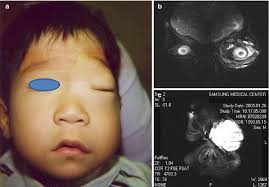 Lymphatic Vascular Malformations of the Limbs: Treatment of Extratruncular  Malformations